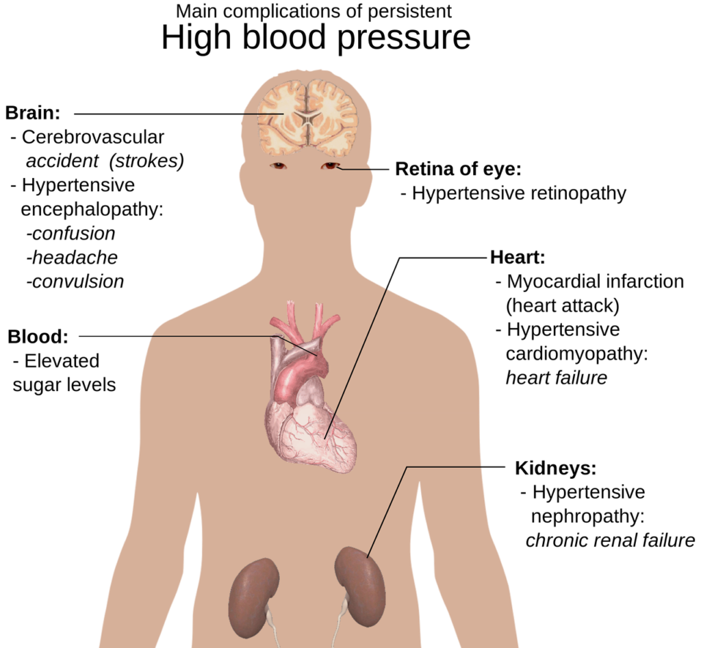 human body anatomy, overview, hypertension-1279987.jpg